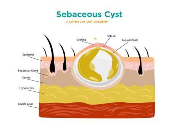 Do cysts smell?