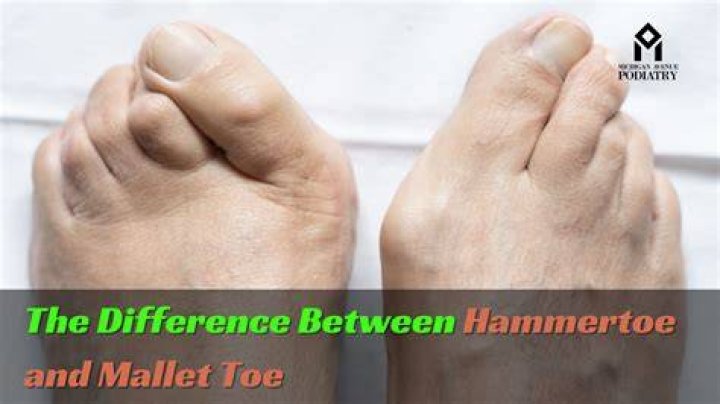 Do hammer toes get worse over time?