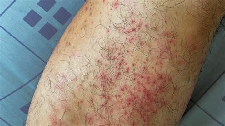 Do hives spread by scratching?