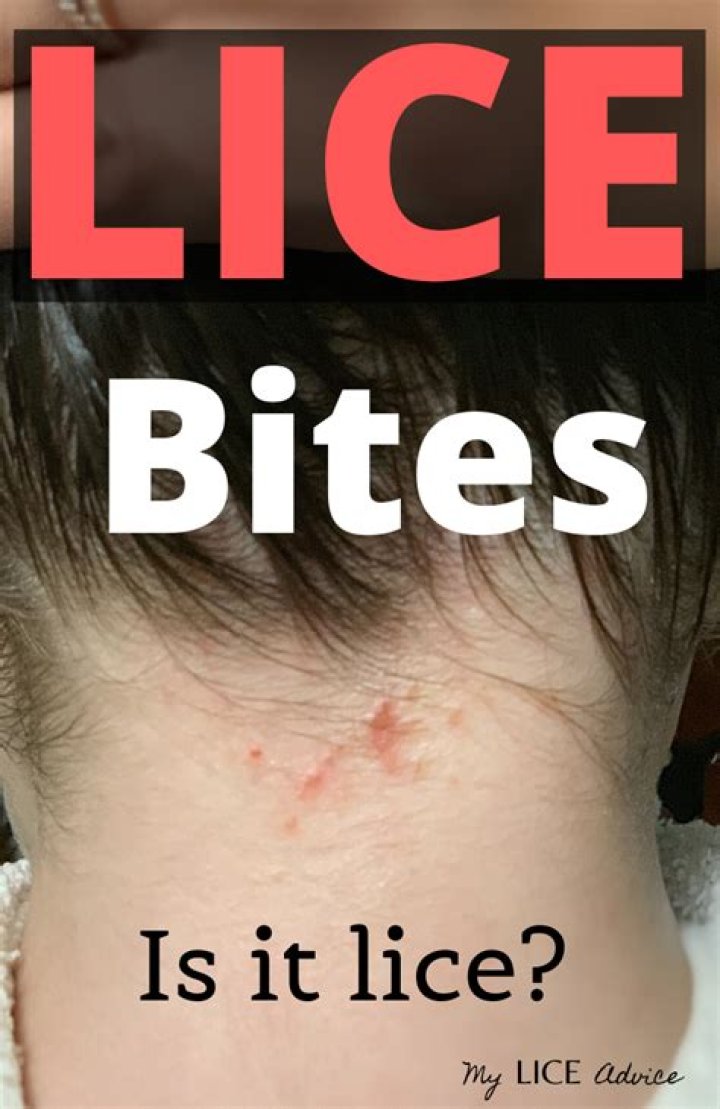 Do lice bites look like pimples?