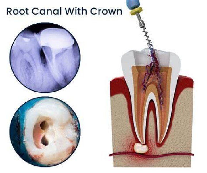 Do root canals need to be done twice?
