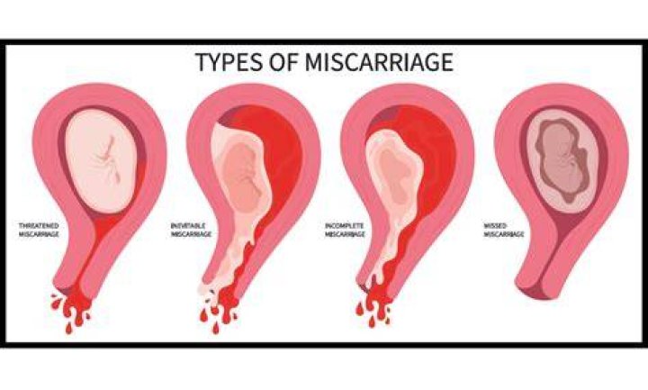 Do you bleed a lot with an early miscarriage?