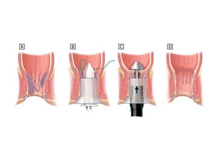 Do you get stitches after hemorrhoidectomy?
