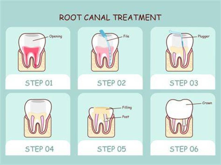 Does a big cavity mean root canal?