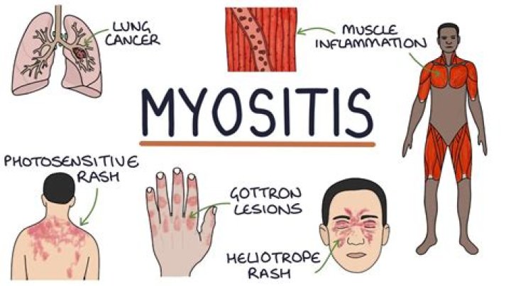 Does a neurologist treat myositis?