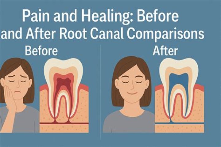 Does a root canal hurt the next day?