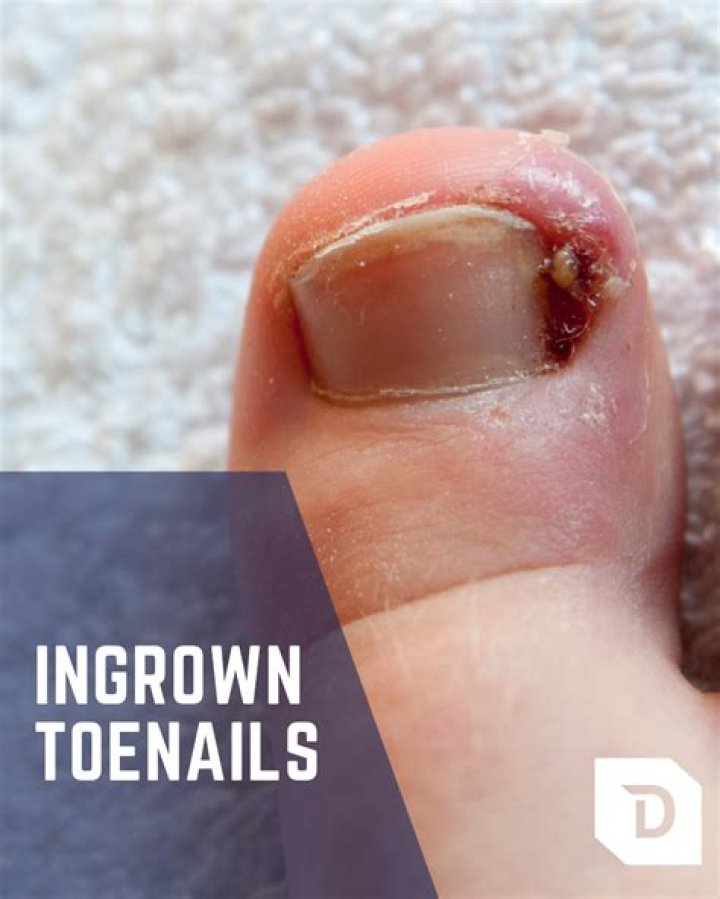Does an ingrown toenail throb?