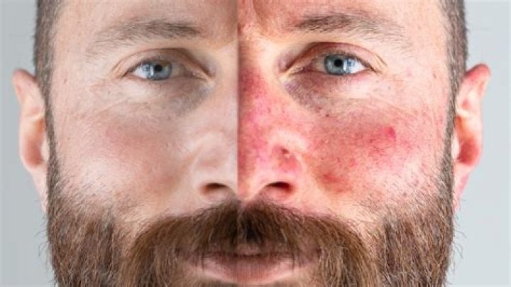 Does bbl help rosacea?