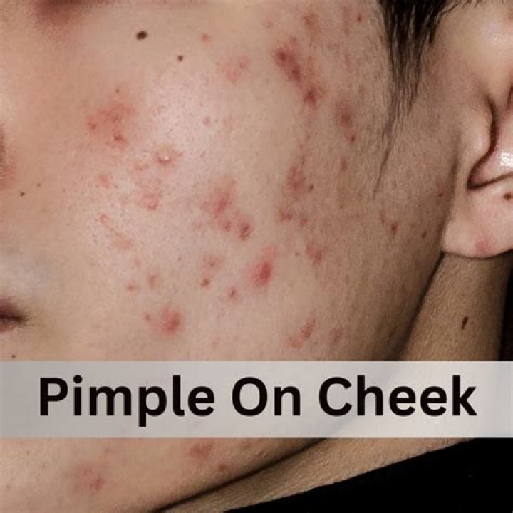 Does being in love cause pimples?