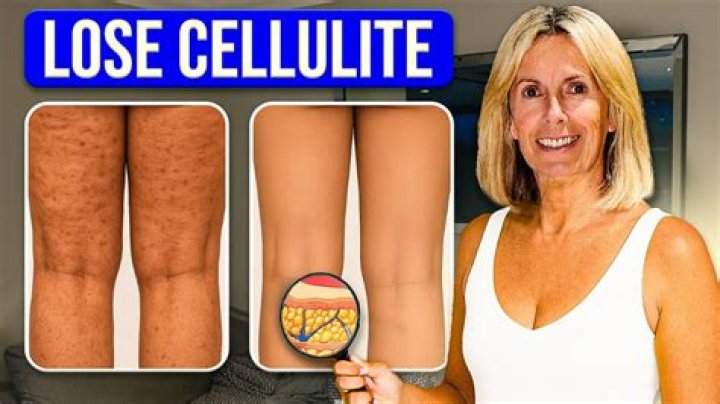 Does collagen remove cellulite?