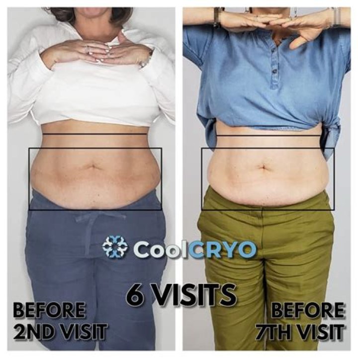Does cryotherapy work on belly fat?
