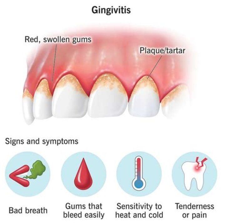 Does fluoride fight gingivitis?