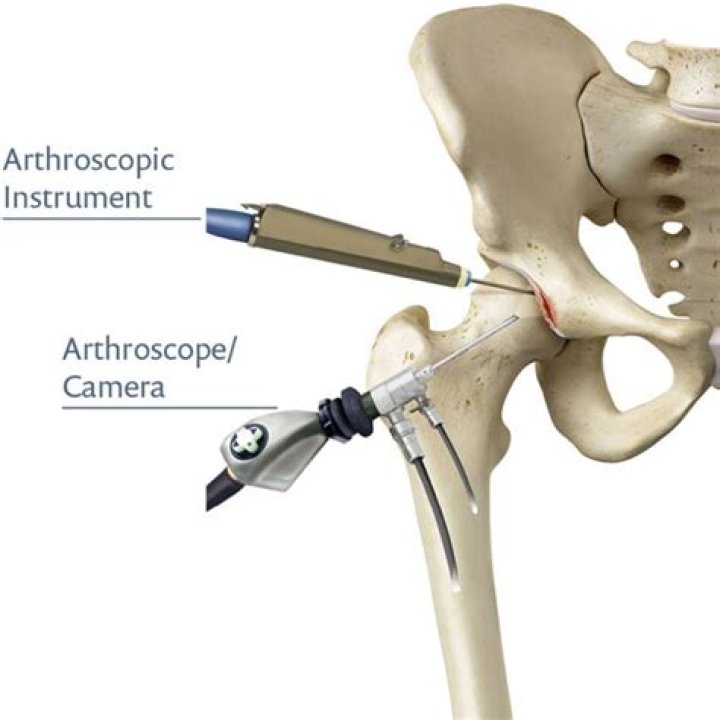Does hip arthroscopy cause arthritis?