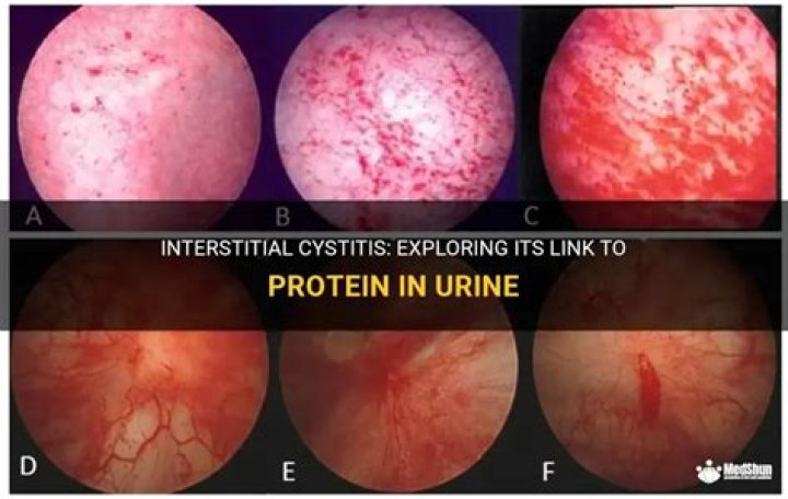 Does interstitial cystitis cause protein in urine?
