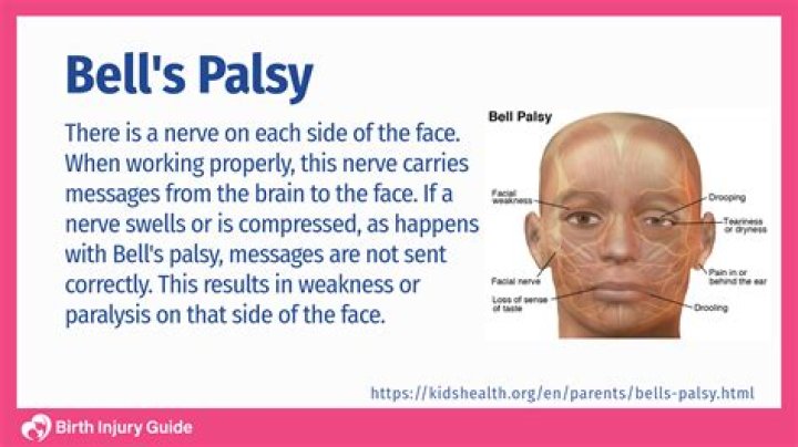 Does Karen Austin still have Bell's palsy?