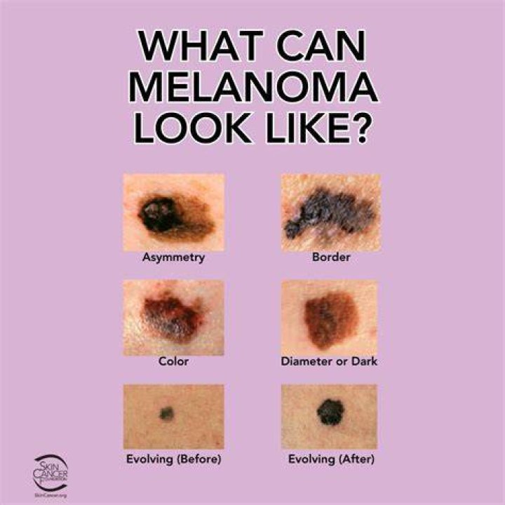 Does melanoma look like a scab?