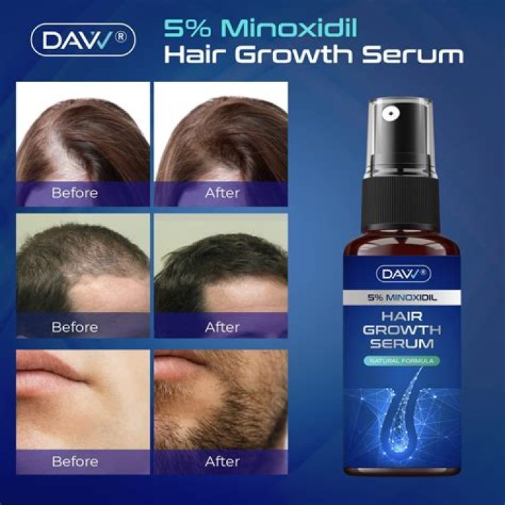 Does minoxidil thicken hair?
