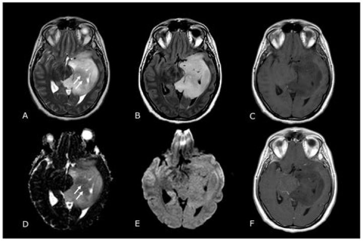 Does Parkinson show up on MRI?