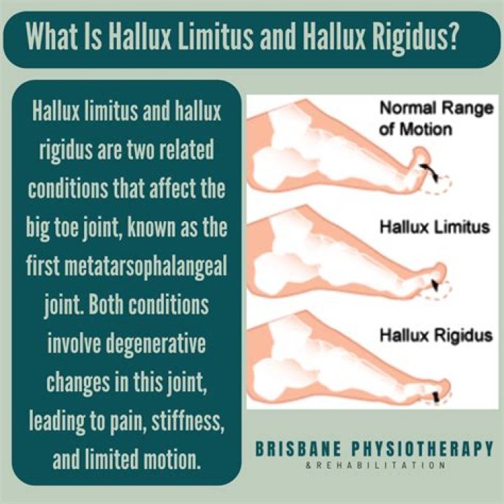 Does physical therapy help hallux rigidus?