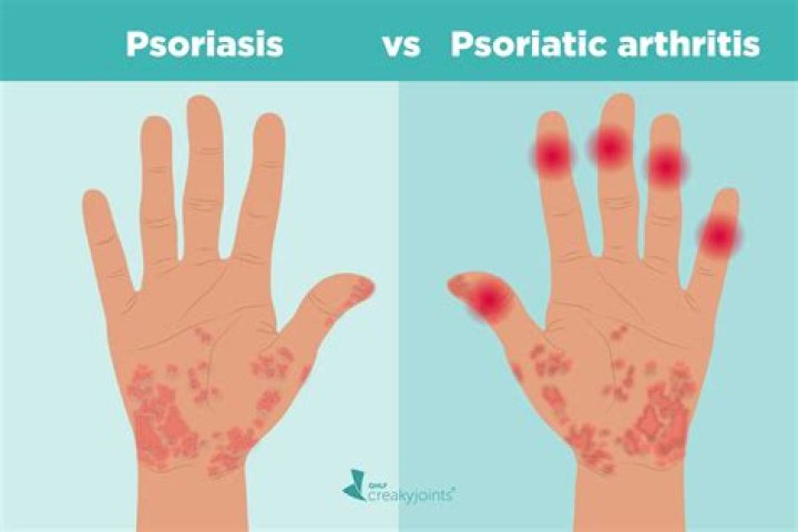 Does psoriatic arthritis show in bloodwork?