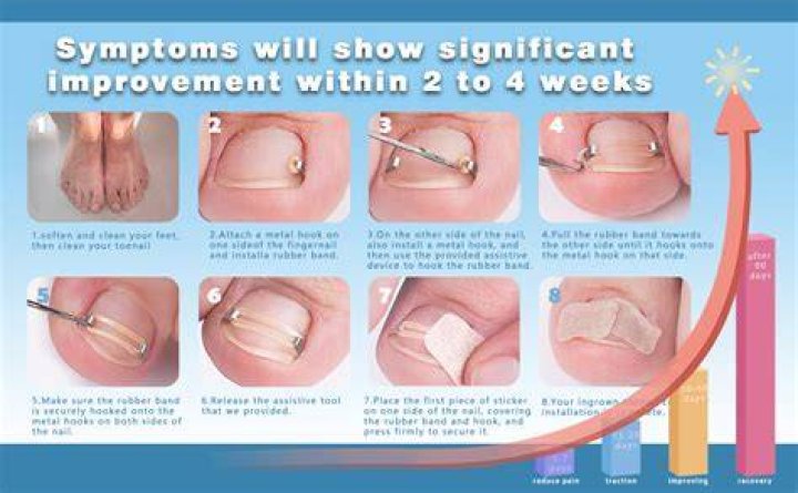 Does putting cotton under ingrown toenail work?