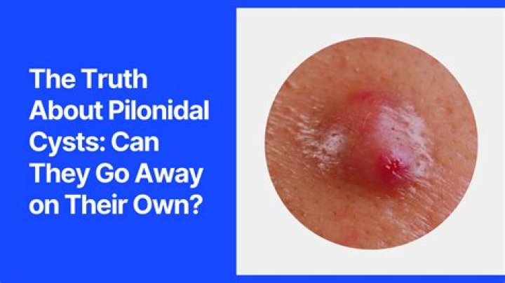 Does removing cysts help PCOS?