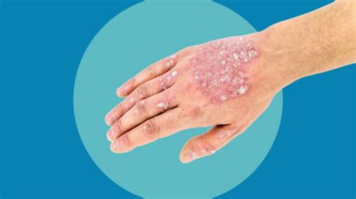 Does salt bath help psoriasis?