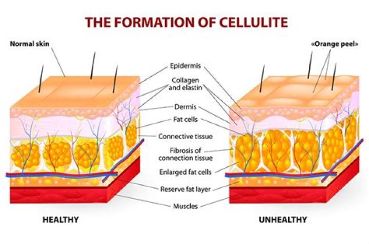 Does Spinning help with cellulite?