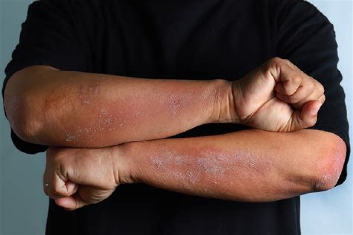Does stress cause psoriasis?