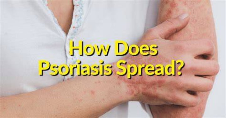 Does sweat trigger psoriasis?