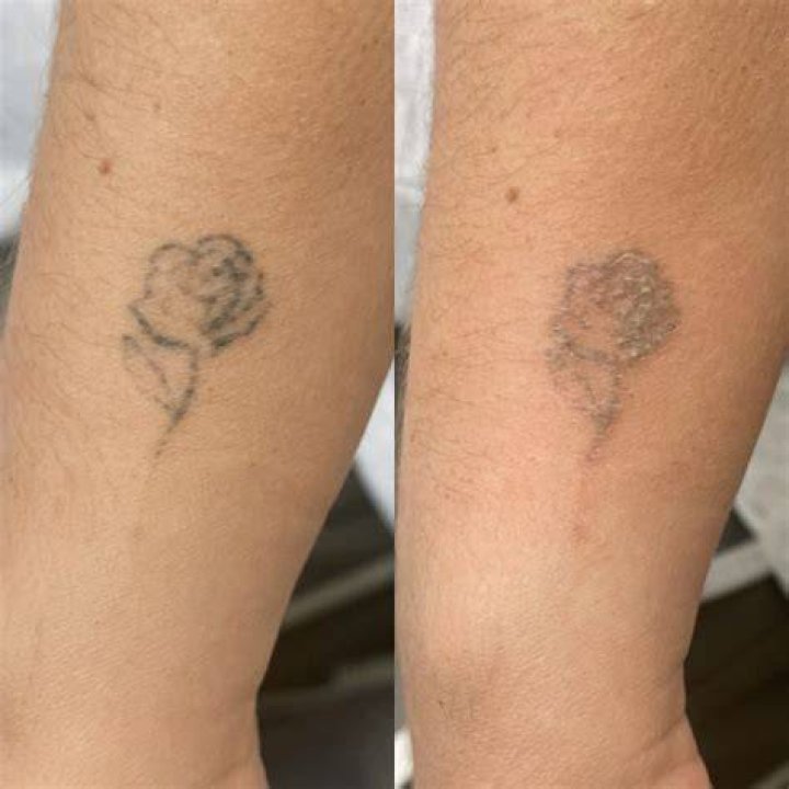 Does tattoo removal damage skin?