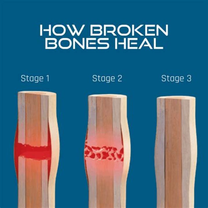 Does vitamin D help heal bones?