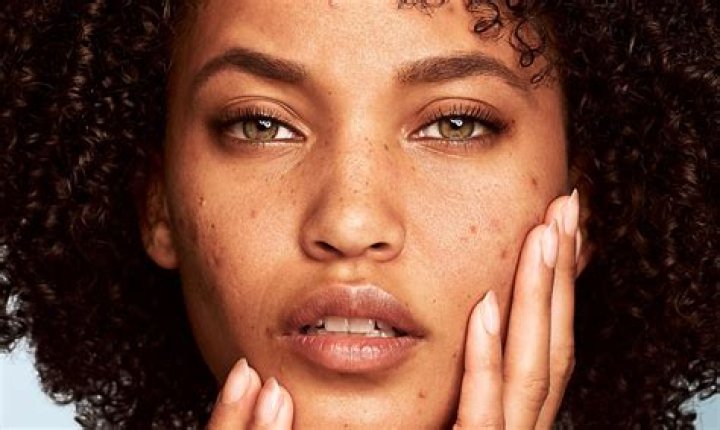 Does vitamin E help with acne?