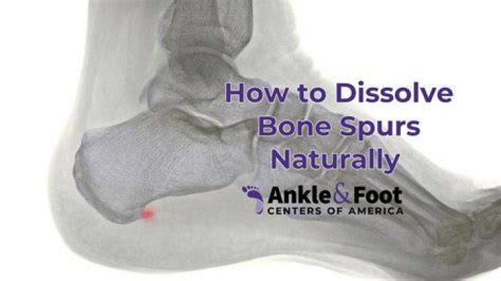 How are bone spurs removed from the foot?
