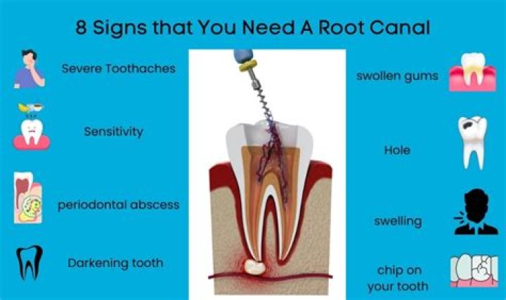 How can a dentist tell if you need a root canal?