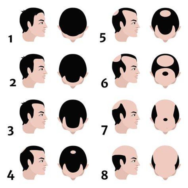 How can I reduce my baldness?