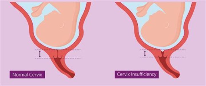 How can you tell if your cervix is open during pregnancy?
