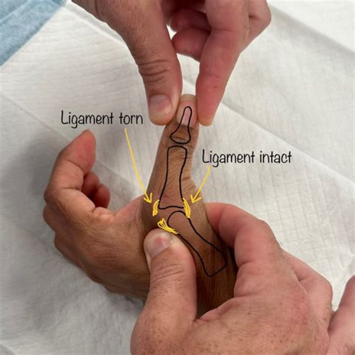 How do doctors check for torn ligaments?