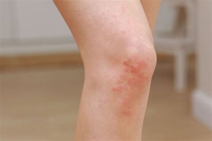 How do I get rid of myositis?