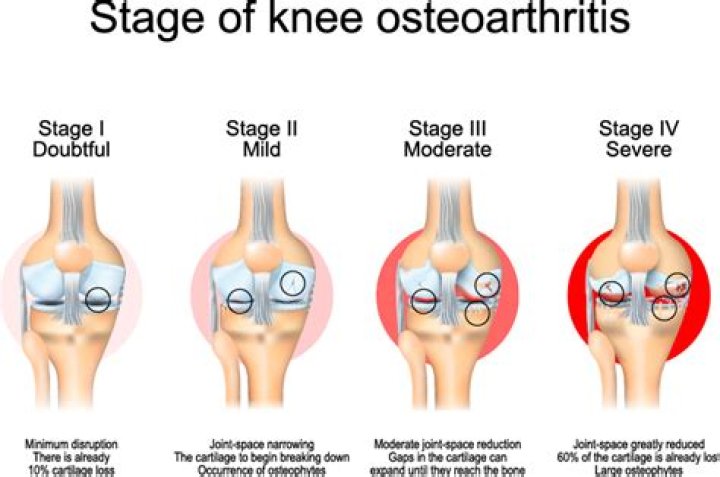 How do I know if I have arthritis in my knee?