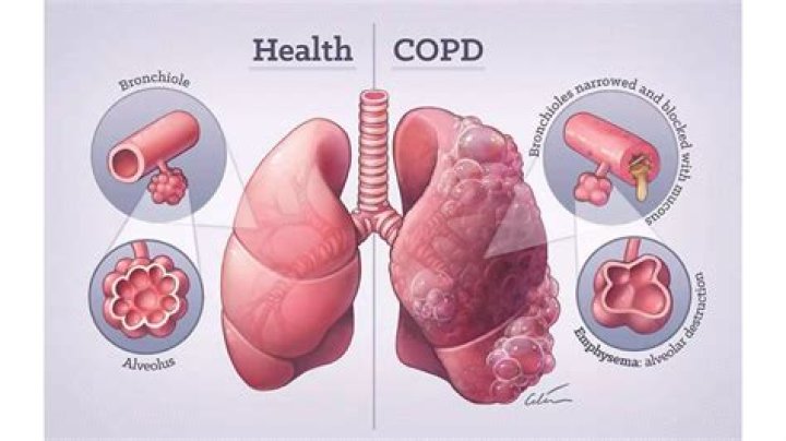 How do I know if I have COPD or asthma?