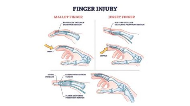 How do I know if my finger is broken or just swollen?