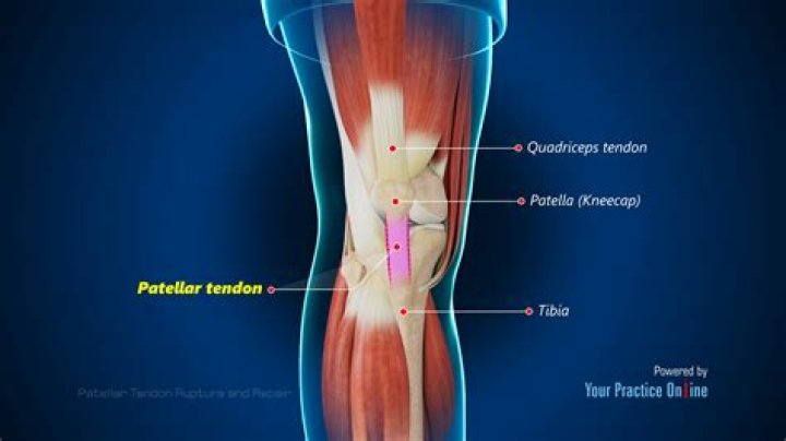 How do I know if my tendon is torn?