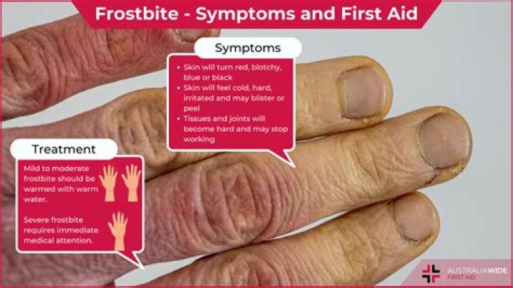 How do NFL players prevent frostbite?