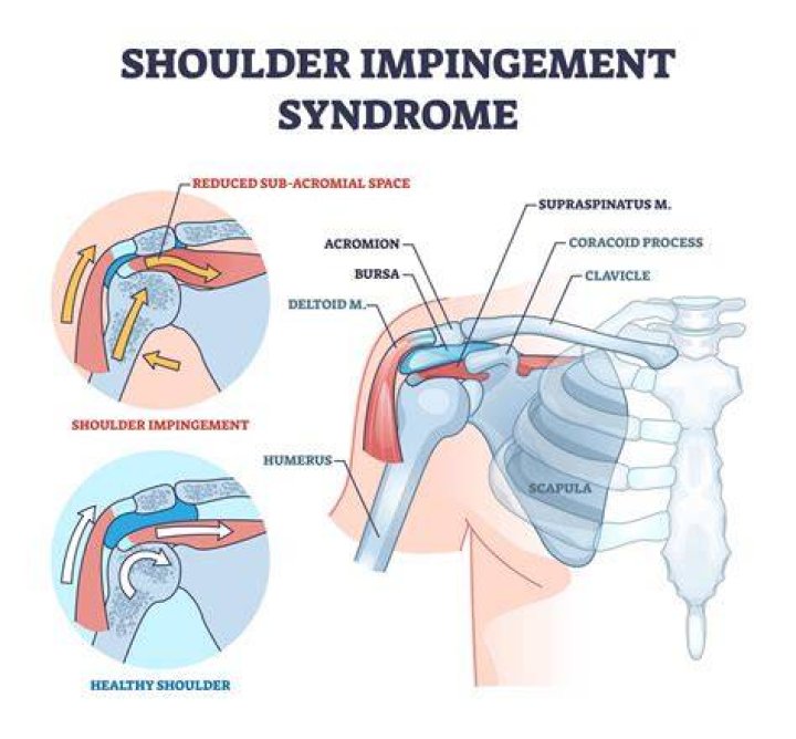 How do you fix arm impingement?