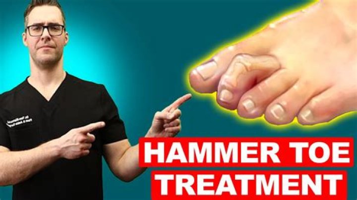 How do you fix hammer toes naturally?