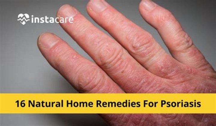 How do you fix psoriasis on your hands?