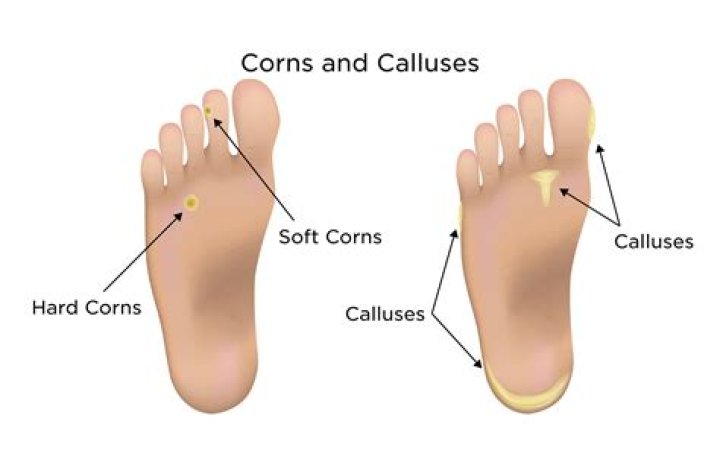 How do you get calluses on your feet?