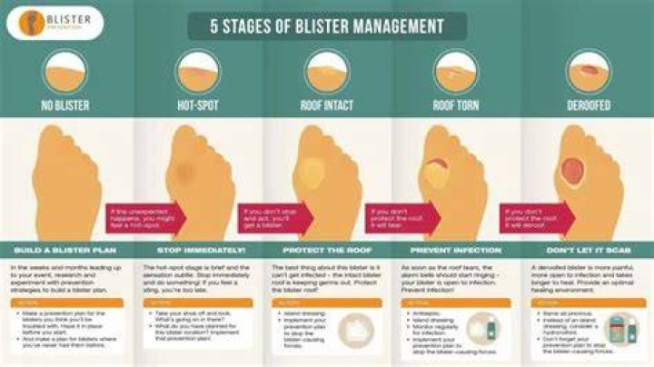 How do you get rid of a blister without popping it?