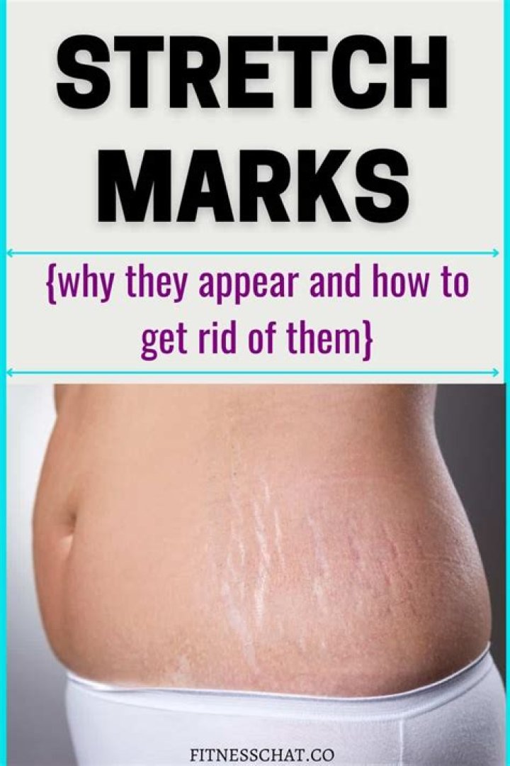 How do you get rid of stretch marks on your thighs fast?